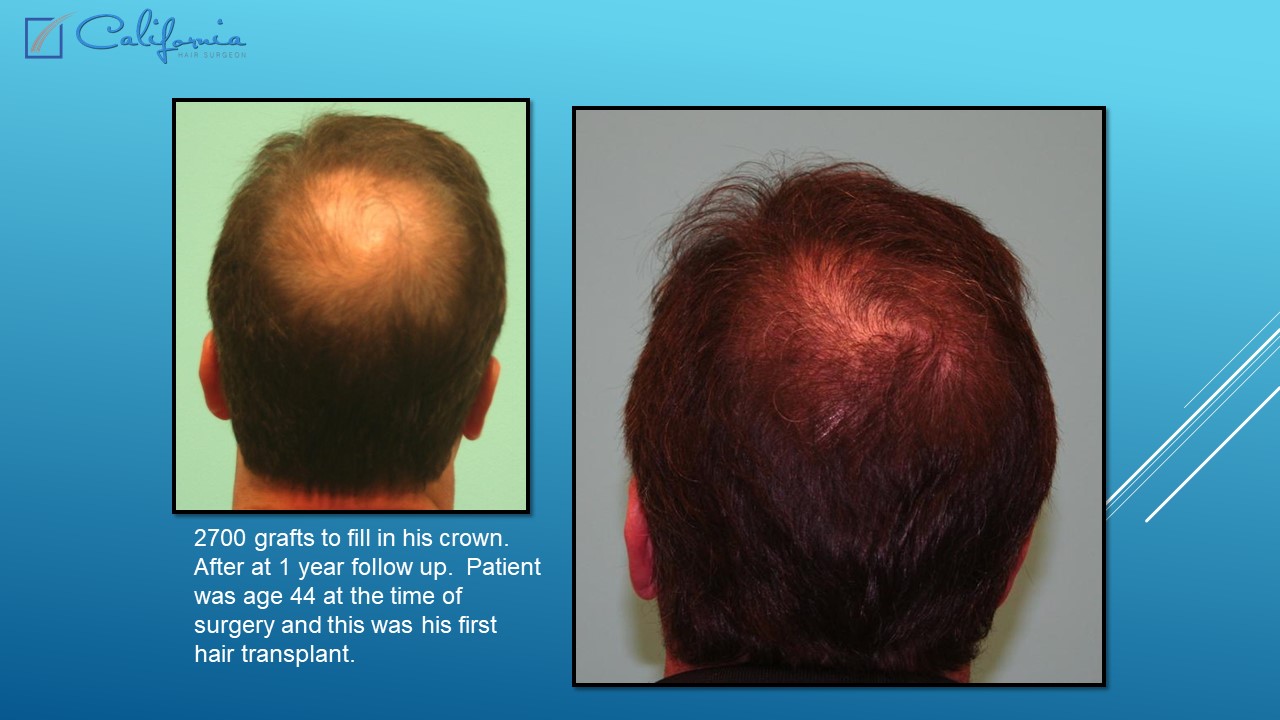 Hair Transplant San Francisco Medical & Surgical Hair Restoration in