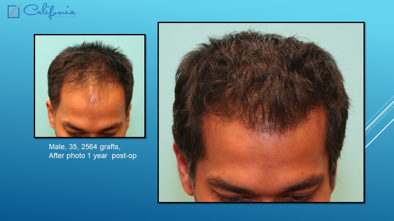 Hair Transplant San Francisco Medical & Surgical Hair Restoration in