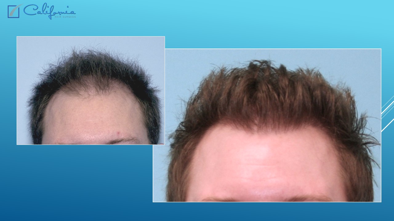 Hair Transplant San Francisco Medical & Surgical Hair Restoration in