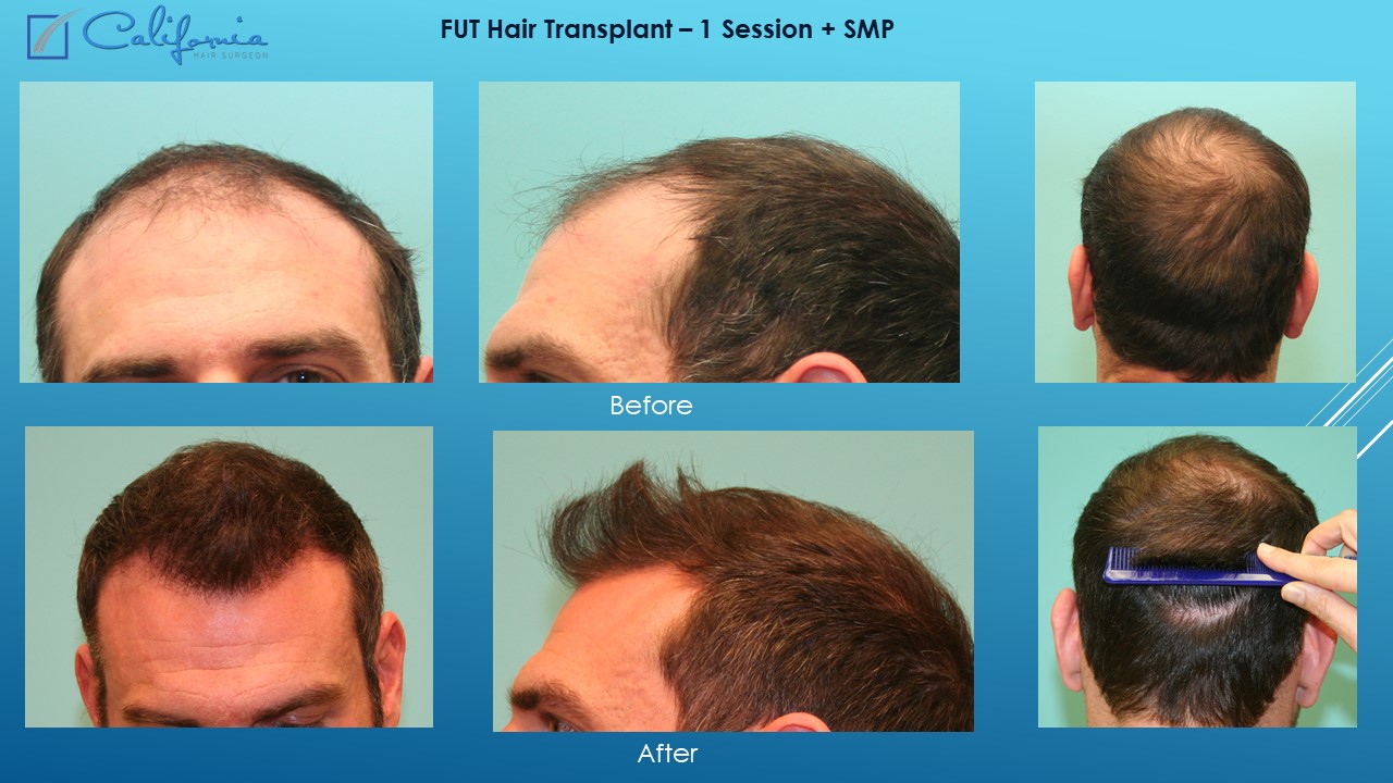 Hair Transplant San Francisco Medical & Surgical Hair Restoration in