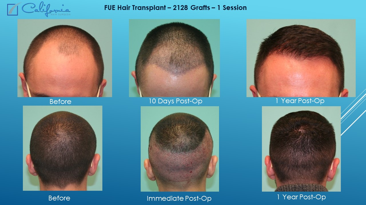 Hair Transplant San Francisco | Medical & Surgical Hair Restoration in