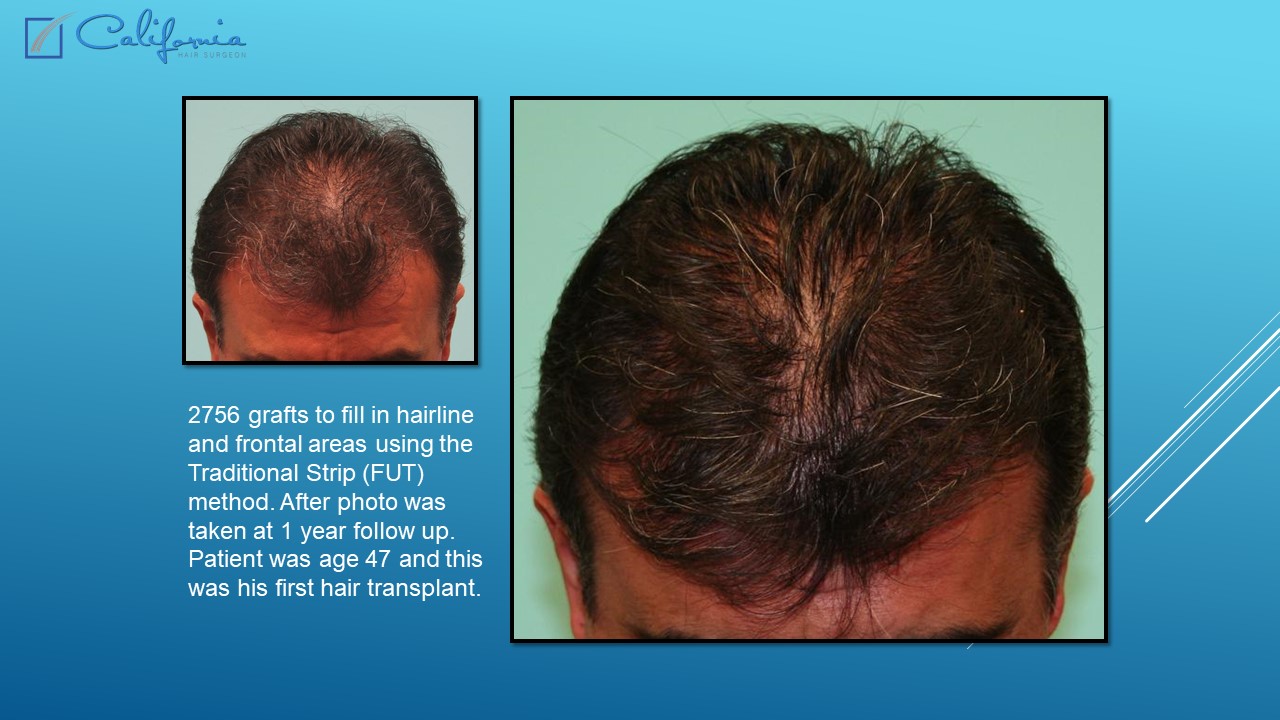 Hair Transplant San Francisco Medical & Surgical Hair Restoration in