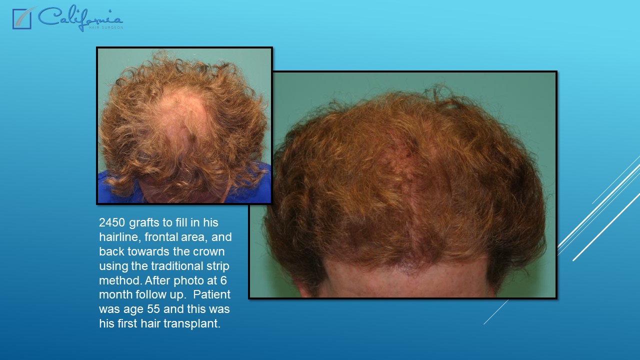 Hair Transplant San Francisco Medical & Surgical Hair Restoration in