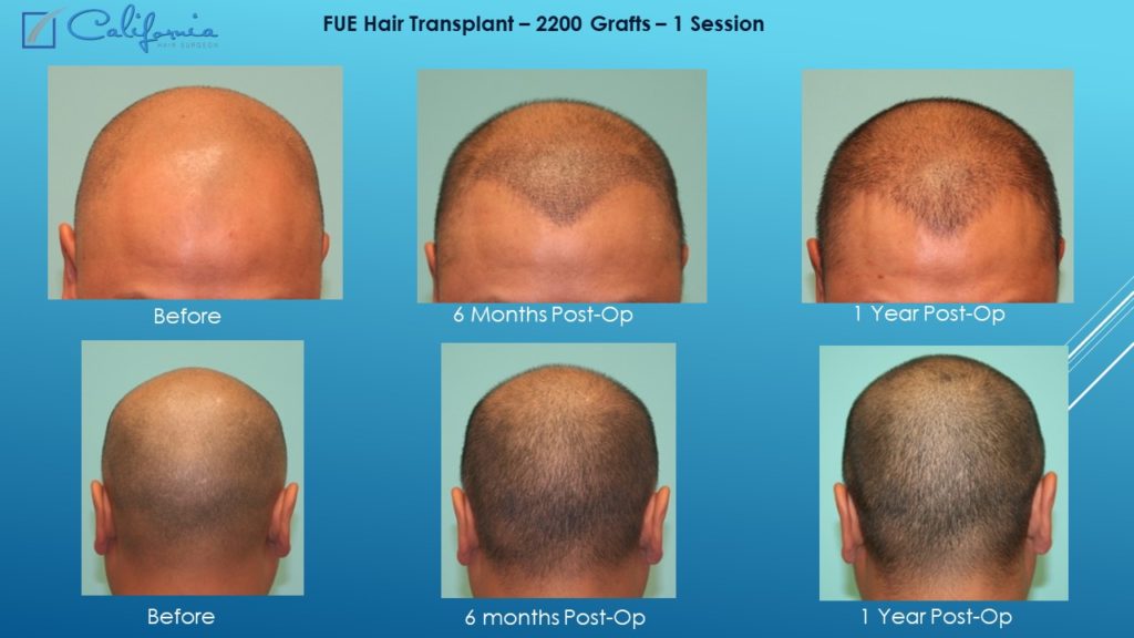 Hair Transplant San Francisco | Medical & Surgical Hair Restoration in SF |  Top Hair Replacement Surgeon in California (CA)