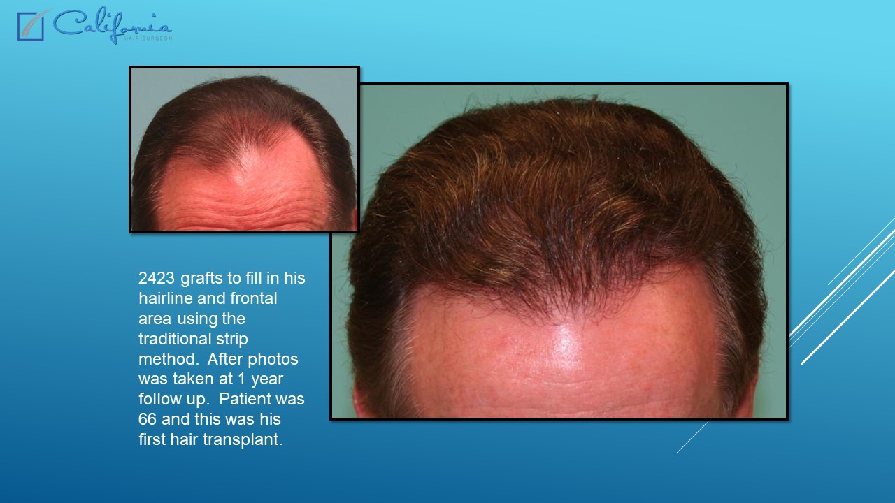 Hair Transplant San Francisco | Medical & Surgical Hair Restoration in