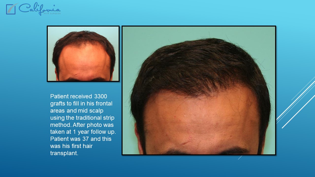 Hair Transplant San Francisco Medical & Surgical Hair Restoration in