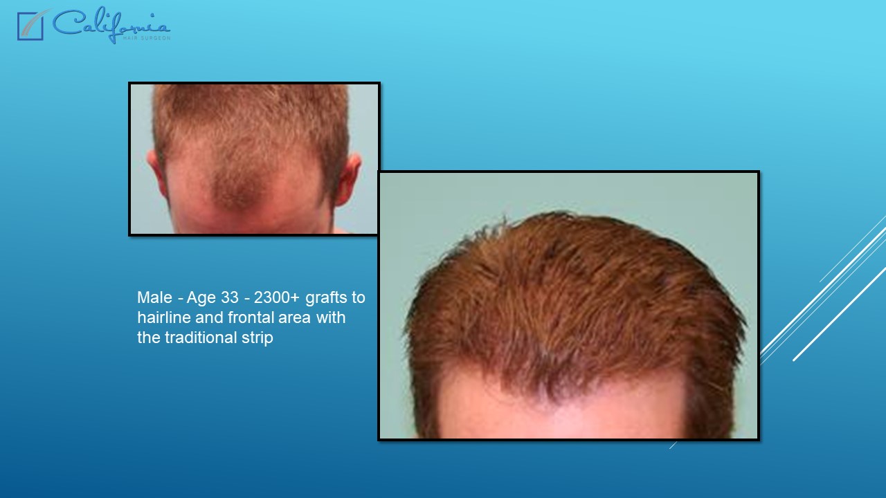 Hair Transplant San Francisco Medical & Surgical Hair Restoration in