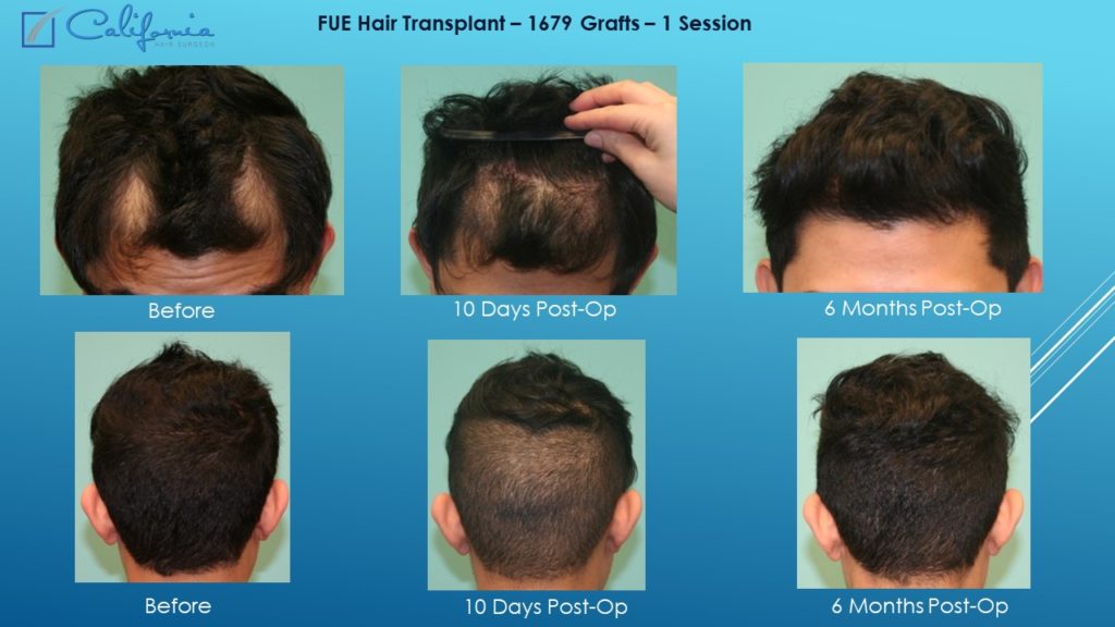 Hair Transplant San Francisco | Medical & Surgical Hair Restoration in SF |  Top Hair Replacement Surgeon in California (CA)