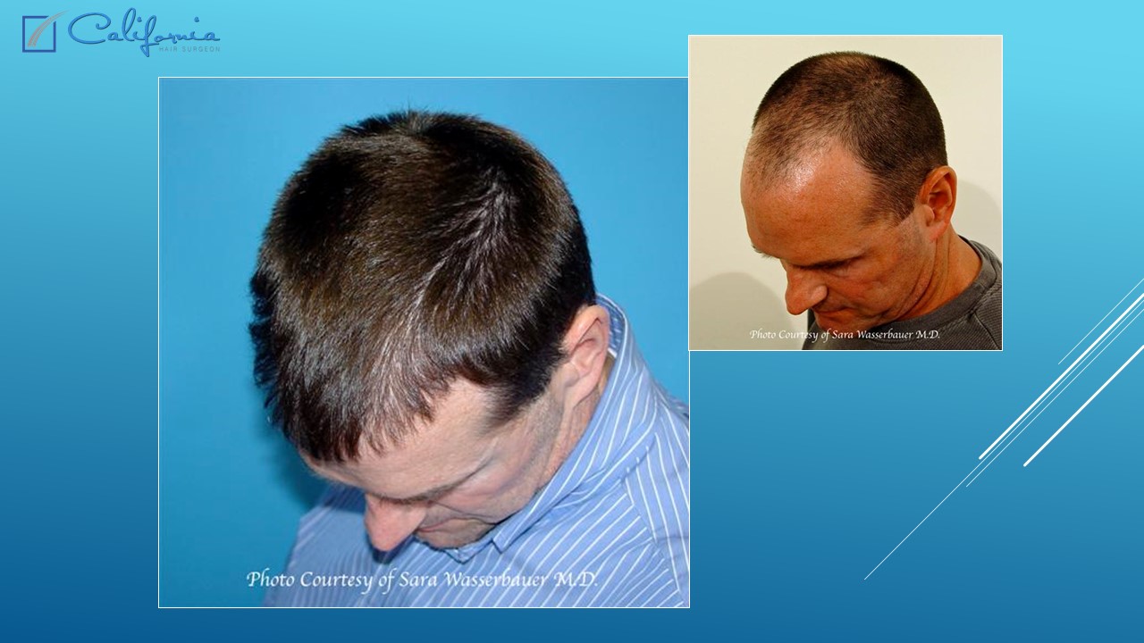 Hair Transplant San Francisco Medical & Surgical Hair Restoration in