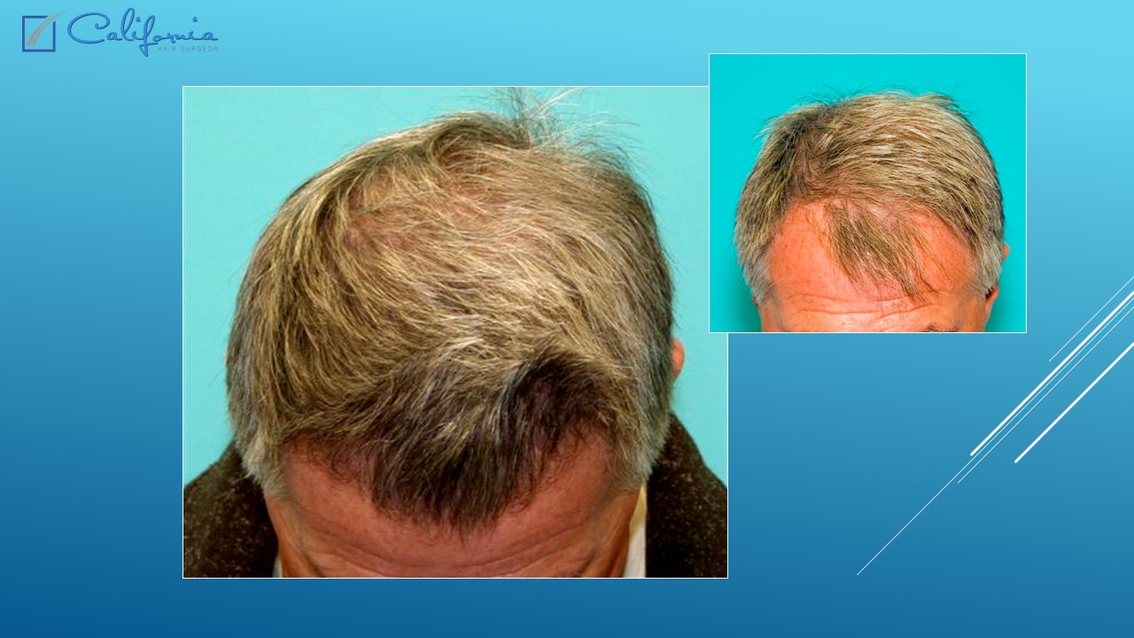Hair Transplant San Francisco | Medical & Surgical Hair Restoration in