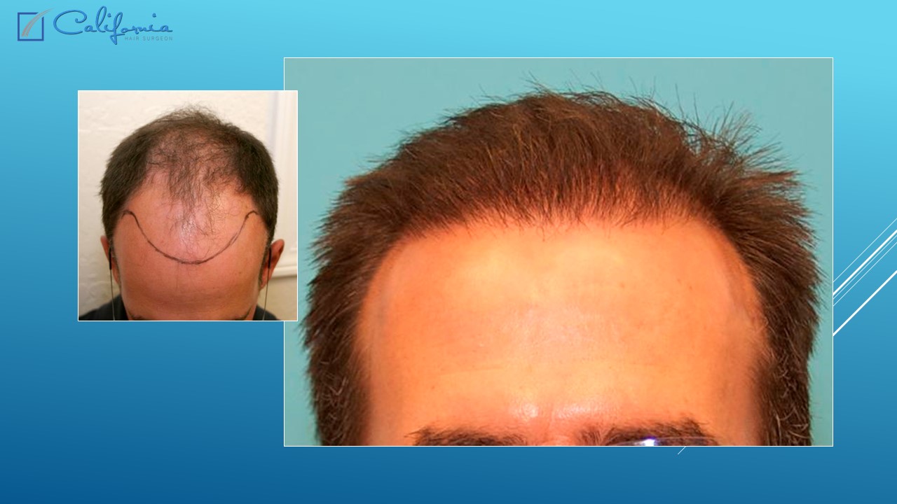 Hair Transplant San Francisco Medical & Surgical Hair Restoration in