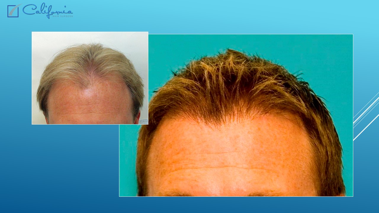 Hair Transplant San Francisco | Medical & Surgical Hair Restoration in