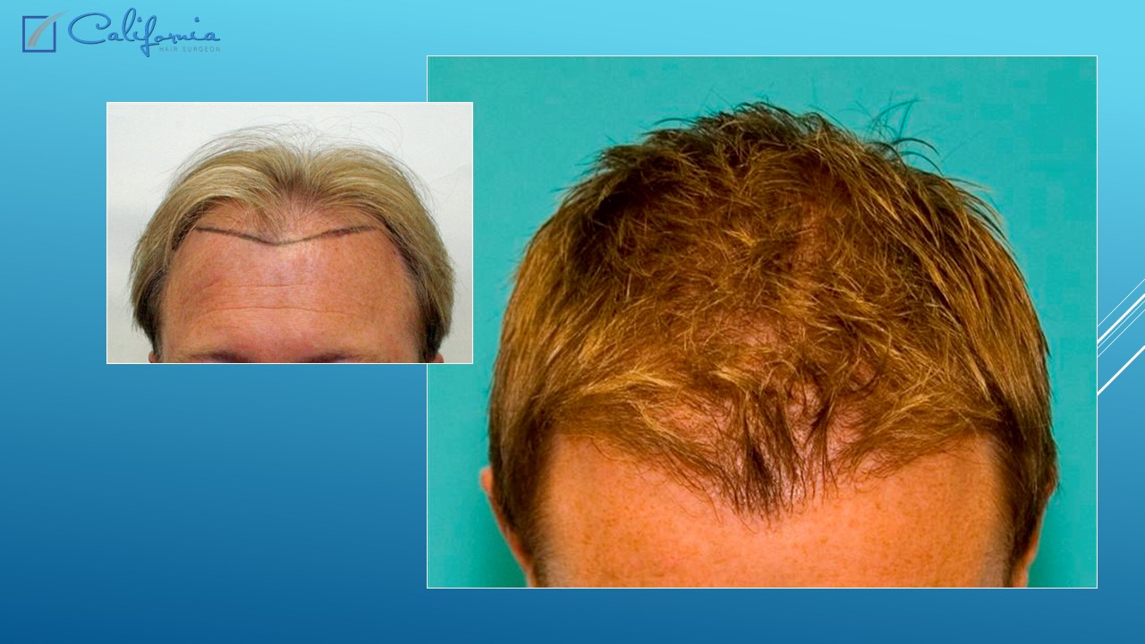 Hair Transplant San Francisco Medical & Surgical Hair Restoration in