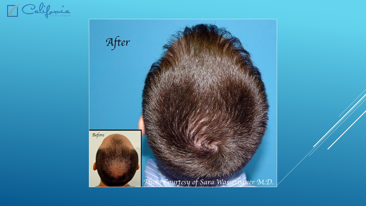 Hair Transplant San Francisco Medical & Surgical Hair Restoration in