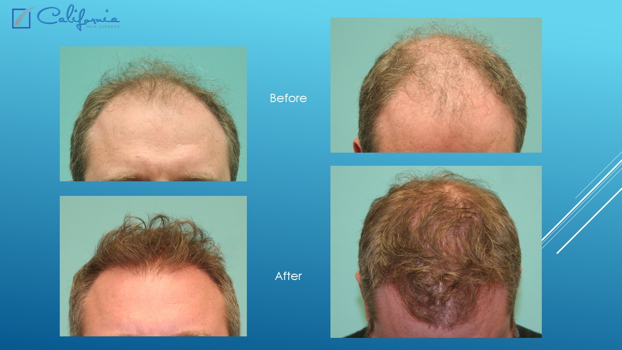 Hair Transplant San Francisco | Medical & Surgical Hair Restoration in